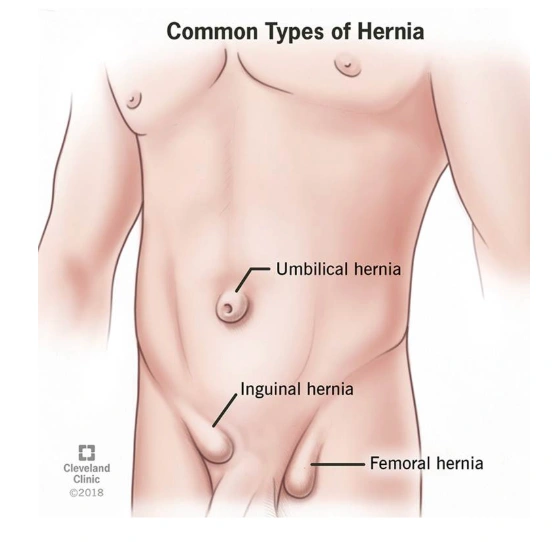 hernia