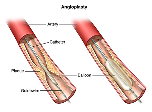 angioplasty